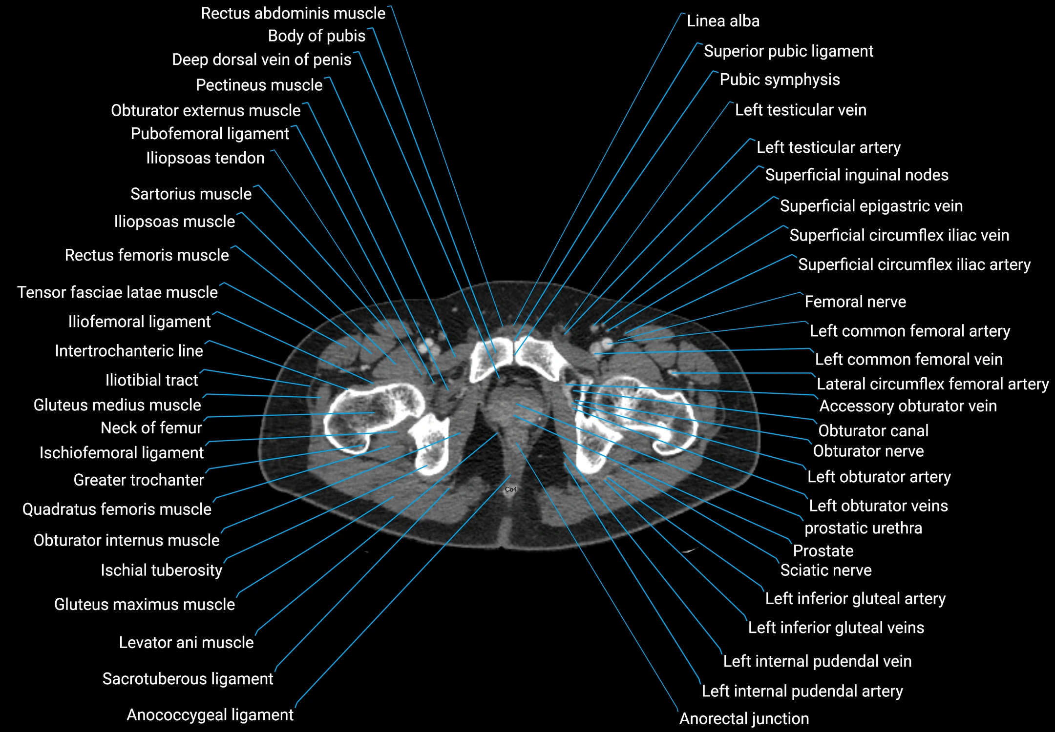 CT male pelvis axial cross sectional anatomy labelled radiology image -00197.webp